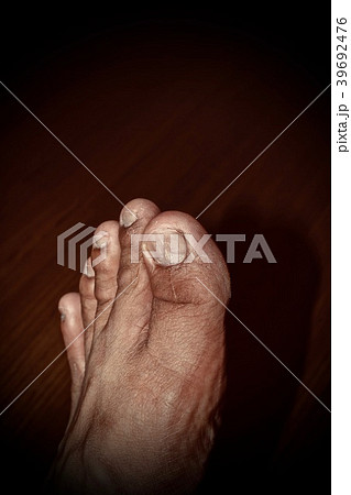 Cracks on the toenail. Cracks on the toenail. 39692476