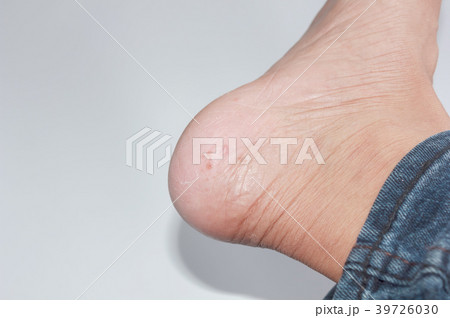Foot fungus on a white background Foot fungus on a white background 39726030