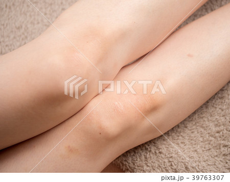 アザがある膝のアップ 39763307