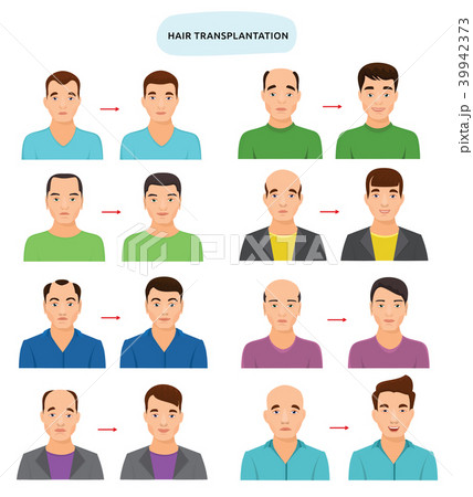 Hair transplant vector hairy transplantation after hairloss and baldness for bald man illustration Hair transplant vector hairy transplantation after hairloss and baldness for bald man illustration 39942373
