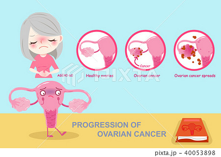 woman with uterine 40053898