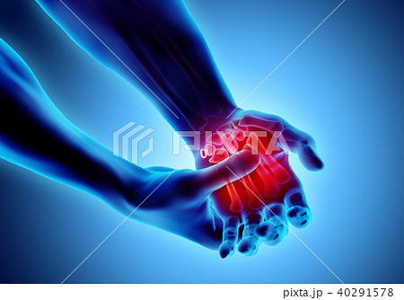 Palm painful - skeleton x-ray, Medical concept. 40291578