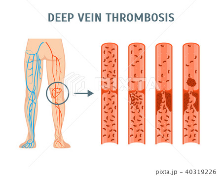 Cartoon Deep Vein Thrombosis Infographics Card Poster. Vector 40319226