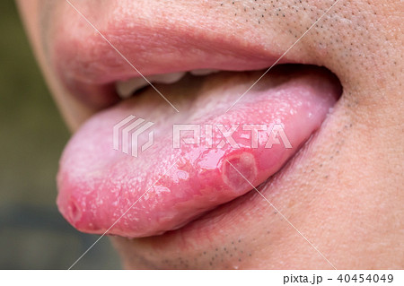tongue with ulcers of adult man 40454049