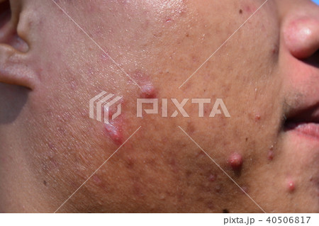 acne on skin face 40506817