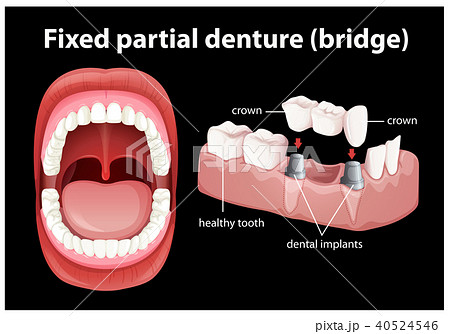 Medical Vector of Fixed Partial Denture 40524546