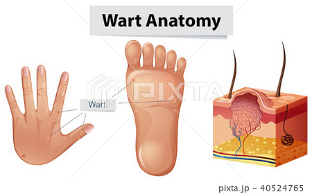 Human Anatomy Wart on Hand and Foot Human Anatomy Wart on Hand and Foot 40524765