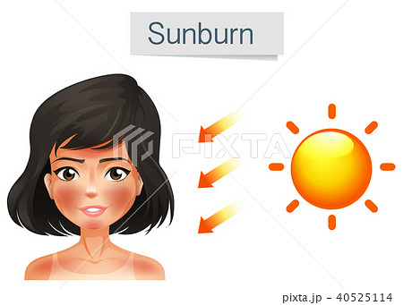 sunburn clip art
