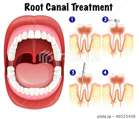Dental Vector of Root Canal Treatment 40525436