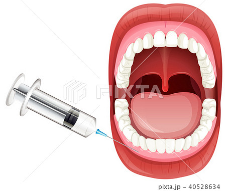Mouth Anatomy showing Gum Injection 40528634