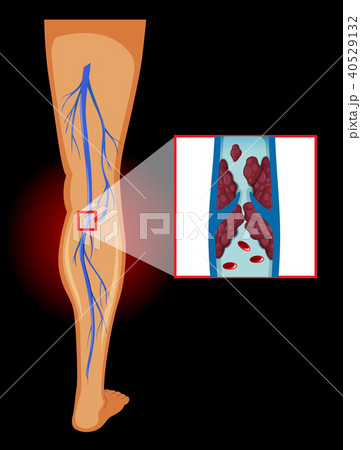 Medical Image of Varicose Veins Medical Image of Varicose Veins 40529132