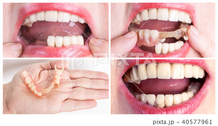 Dental rehabilitation with upper and lower prosthesis, before and after treatment 40577961