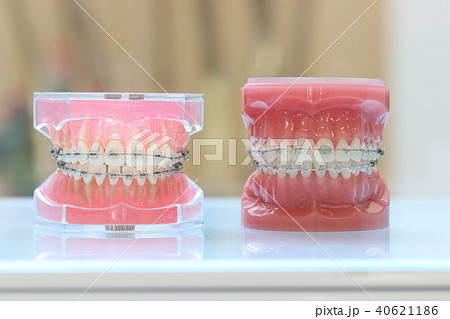 歯科矯正模型 40621186