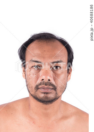Stitch Scars on face and bald head of young man 40688186