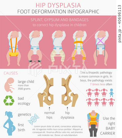 Medical infographic. Hip dysplasia 40696113