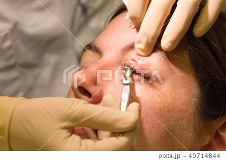Chalazion during eye examination and operation 40714844