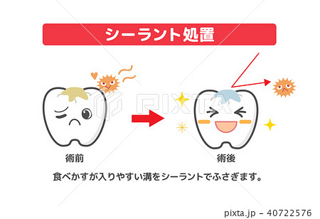 シーラント治療の説明 歯の断面図のイラスト素材