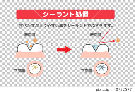 Description of sealant treatment Cross section of teeth 40722577