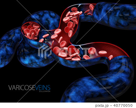 Varicose veins close up 40770050