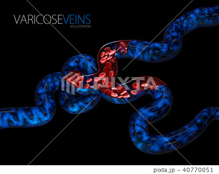 Varicose veins close up. Varicose veins close up. 40770051