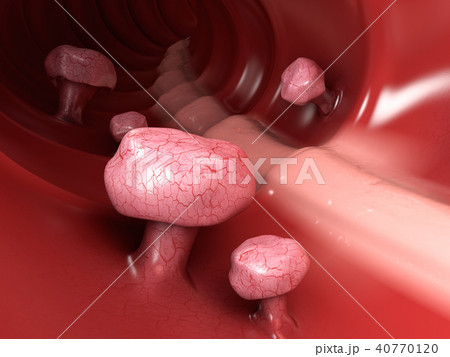 Colon polyps. Polyp in the intestine Colon polyps. Polyp in the intestine 40770120
