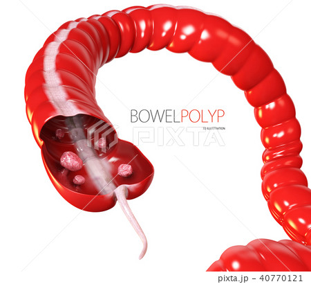 Colon polyps. Polyp in the intestine 40770121