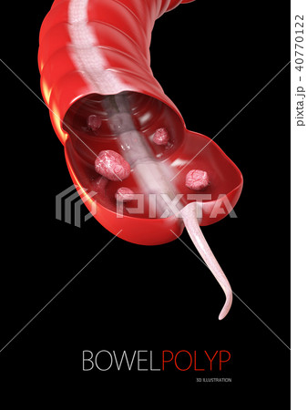 Colon polyps. Polyp in the intestine 40770122