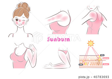 woman with sunburn problem 40783693
