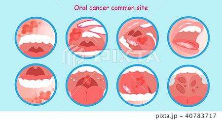 Oral Cancer Commom Siteのイラスト素材
