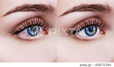 Itchy and irritated female eye. Itchy and irritated female eye. 40875384