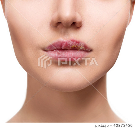 Sore female lips with herpes disease. Sore female lips with herpes disease. 40875456
