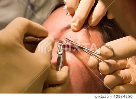 Healthcare concept - Chalazion during eye examination and operat Healthcare concept - Chalazion during eye examination and operat 40934250