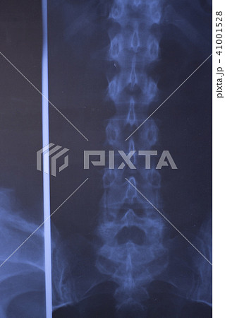 Medical xray spine hip scan 41001528