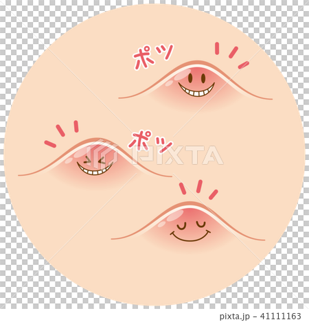 痤瘡粉刺 41111163