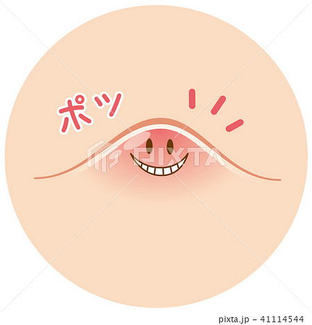 ニキビ 吹き出物 ニキビ 吹き出物 41114544