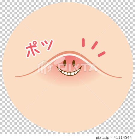 ニキビ 吹き出物 ニキビ 吹き出物 41114544