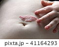 Capillary hemangioma regression. Red birthmark on the baby's belly after treatment 41164293
