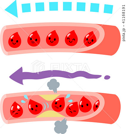 正常な血管と詰まった血管のイラスト素材