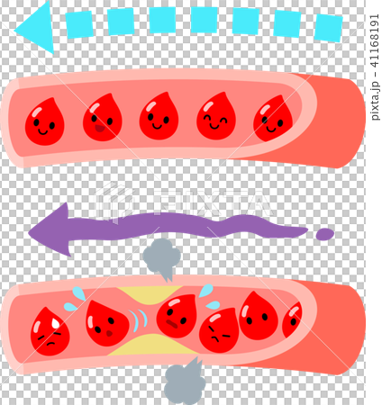 正常な血管と詰まった血管のイラスト素材