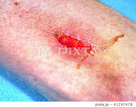 Embracing injured leg with painful place.  41297478