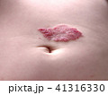 Capillary hemangioma regression. Red birthmark on the baby's belly after treatment 41316330