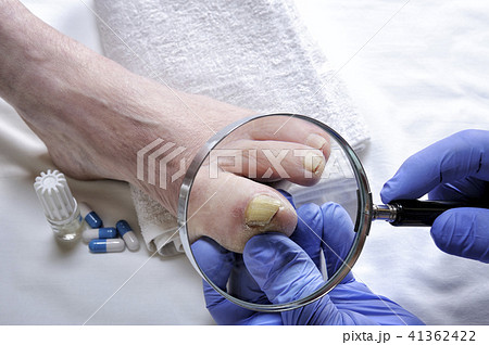 Onychomycosis, nail disease caused by fungi Onychomycosis, nail disease caused by fungi 41362422