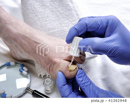 Onychomycosis, nail disease caused by fungi Onychomycosis, nail disease caused by fungi 41362948