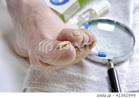 Onychomycosis, nail disease caused by fungi Onychomycosis, nail disease caused by fungi 41362949