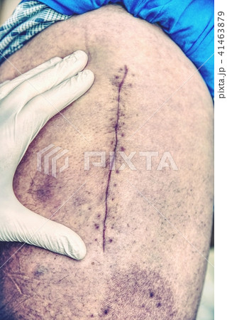 Selective focus of old human leg with scar. Selective focus of old human leg with scar. 41463879