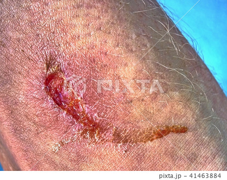 Skin wound. Wet Abrasion. Deep wound on the skin Skin wound. Wet Abrasion. Deep wound on the skin 41463884