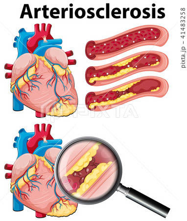 A Heart with Arteriosclerosis on White Background A Heart with Arteriosclerosis on White Background 41483258