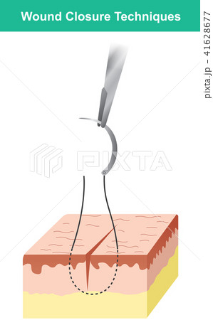 Wound closure techniques Isolate. Illustration Wound closure techniques Isolate. Illustration 41628677