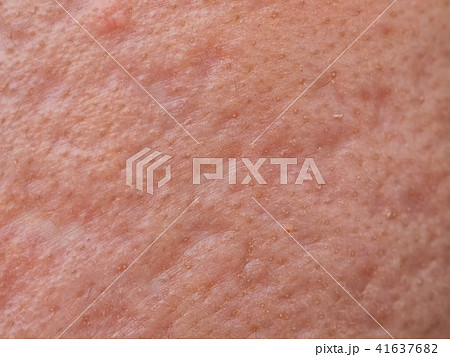 closeup skin problems, nodular cystic acne skin 41637682