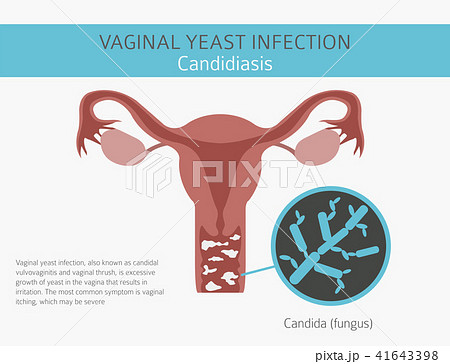 Vaginal yeast infection. Ginecological infographic 41643398